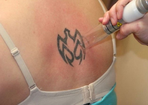Back Tattoo Laser Removal