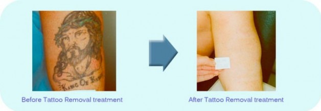 Best Tattoo Removal Therapy Treatment