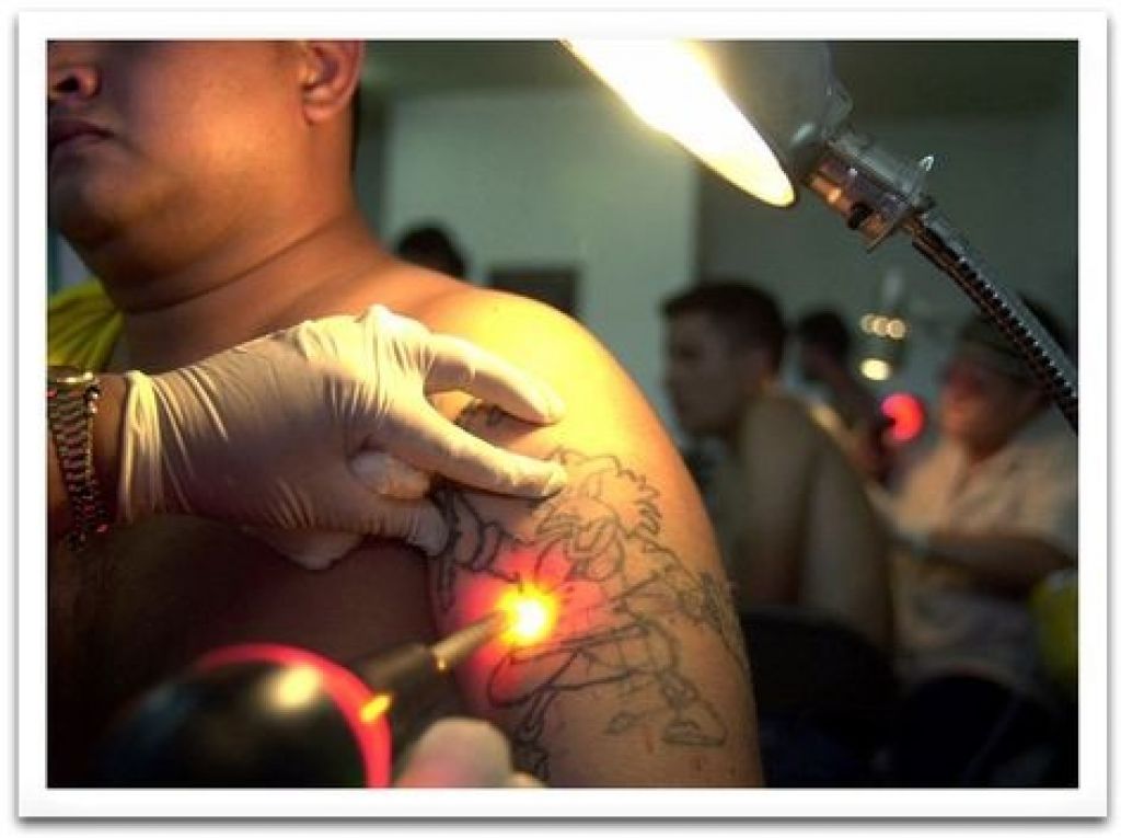 How Effective Is Laser Tattoo Removal Cost Estimation Pictures How Effective Is Laser Tattoo Removal Cost Estimation Pictures