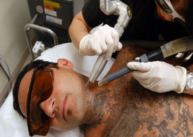 Laser Tattoo Removal Equipments Laser Tattoo Removal Equipments