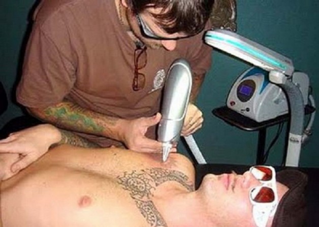 Tattoo Laser Removal Process