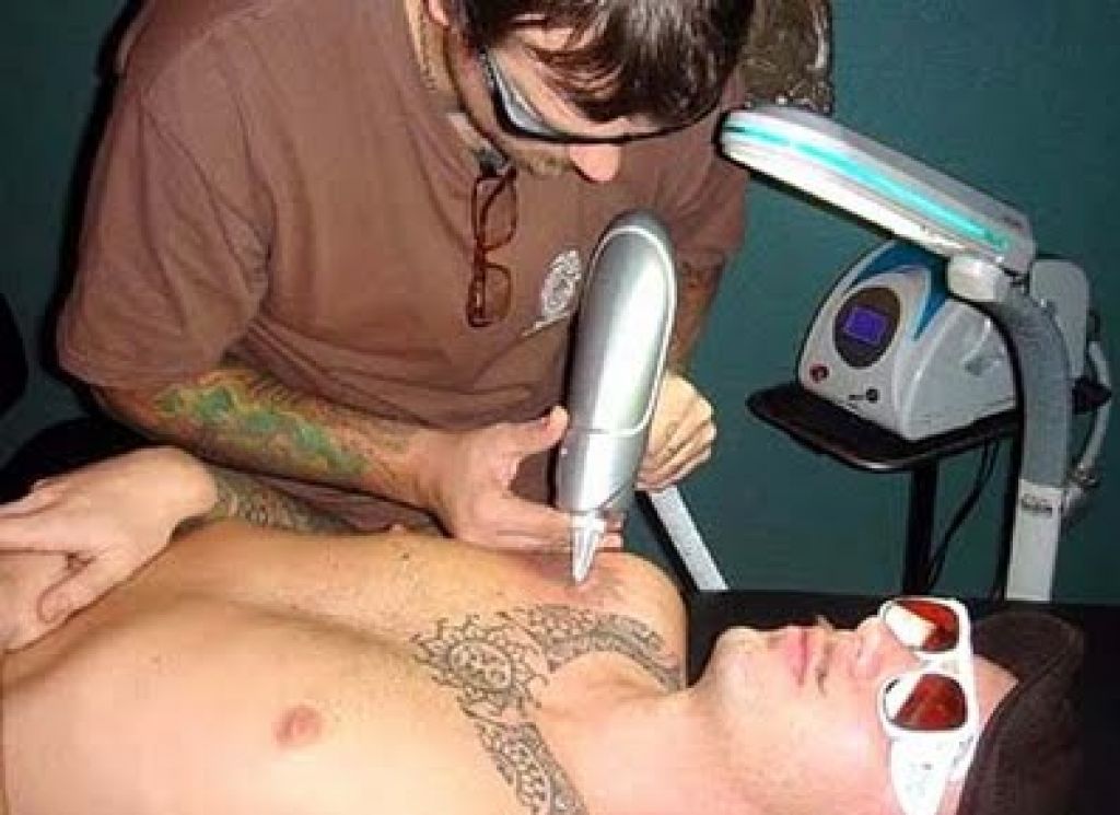 Tattoo Professional Laser Removal Treatment Pictures Tattoo Professional Laser Removal Treatment Pictures